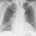 Pneumonia Chest X-ray