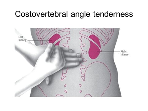Costovertebral angle tenderness