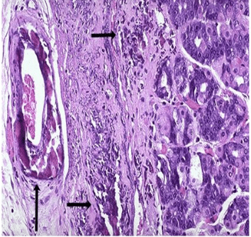 Pathological calcification