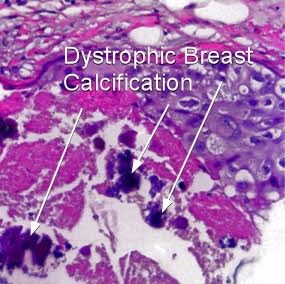 icd 10 code for dystrophic calcification breast