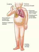 Insuficiencia Cardiaca