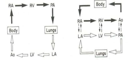 transposition of great arteries