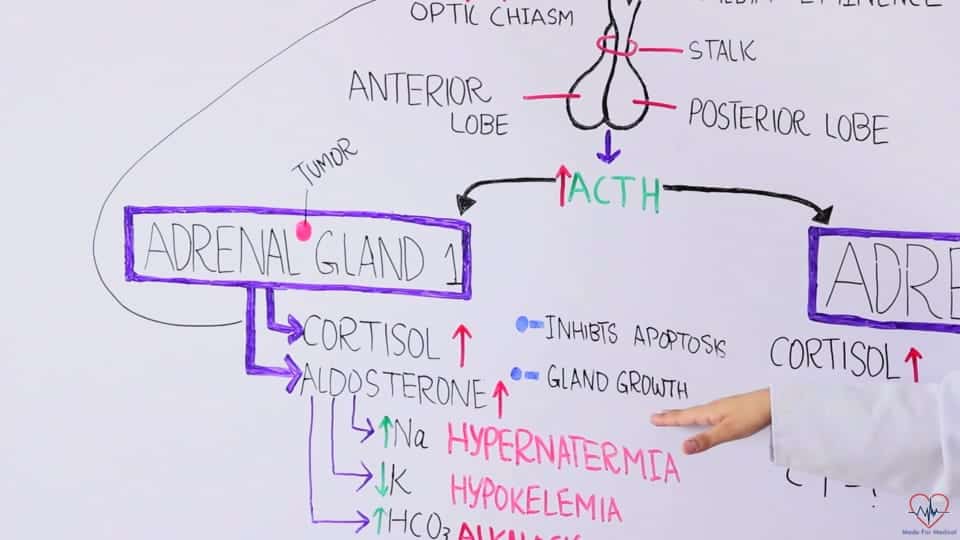 Adrenal gland tumors