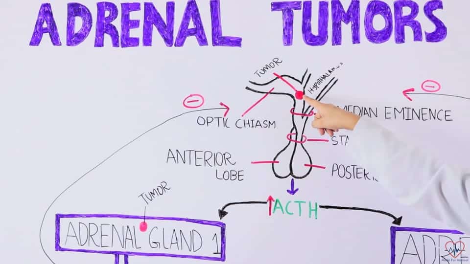 Adrenal gland tumors