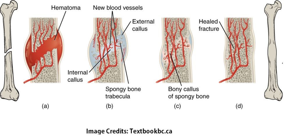 Bone Fractures