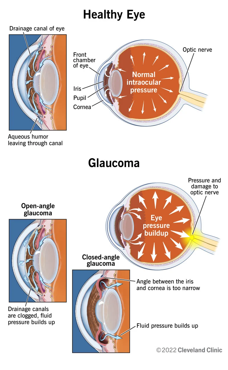 nursing care plan for glaucoma