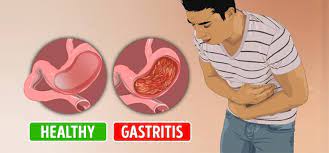 nursing care plan for gastritis