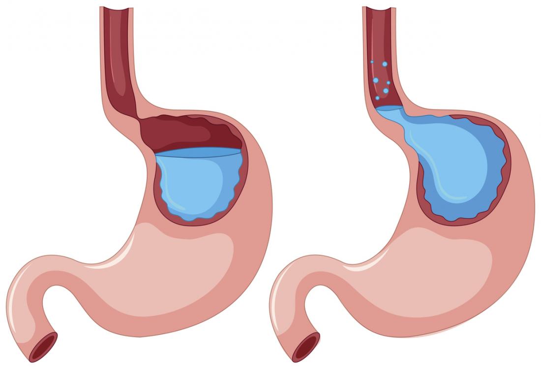 nursing care plan for gerd