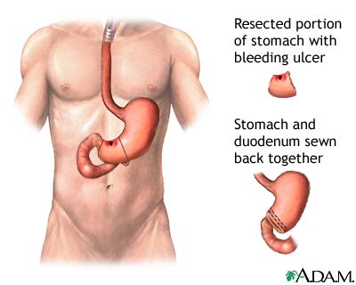 nursing care plan for gi bleed